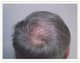 Slider image (5) ProHAIR Transplant Clinic